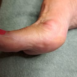 eelt verwijderen pedicurebehandeling ursem noord holland na