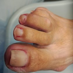 eelt verwijderen voor pedicurebehandeling ursem noord holland nagels lakken