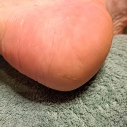 hielkloven na behandeling pedicure praktijk marieke scheringa