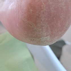 hielkloven voor behandeling pedicure praktijk marieke scheringa